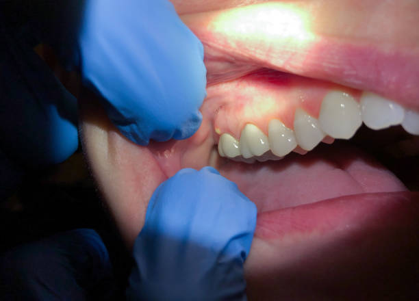 Best Emergency Broken Tooth Repair in Timberwood Park, TX